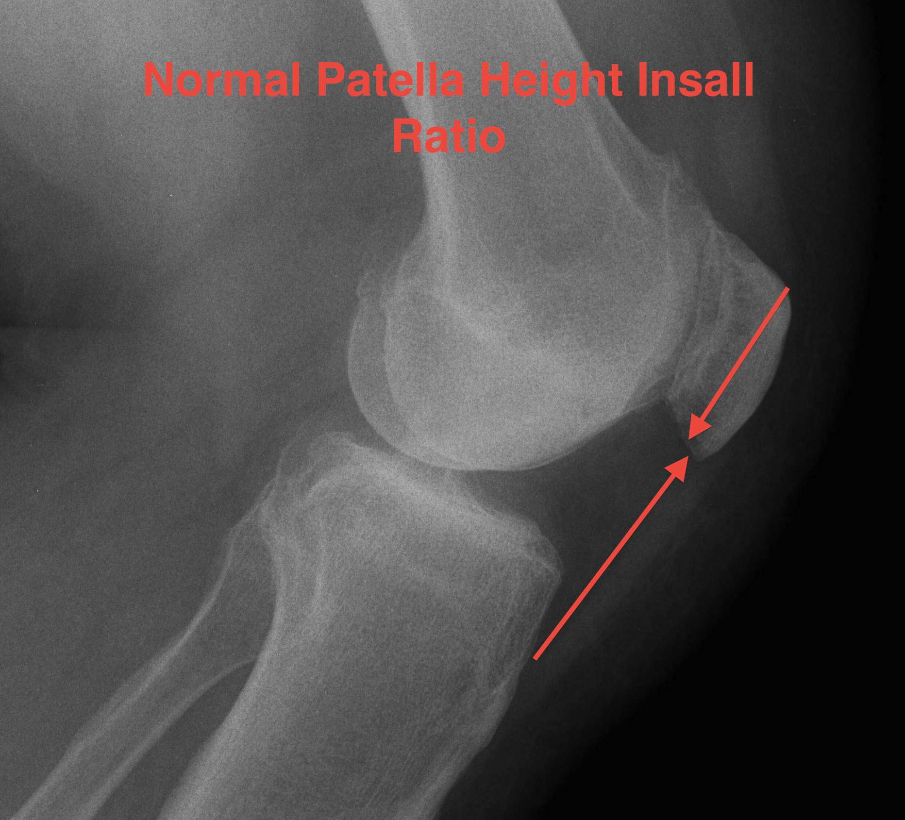Patella Height Normal Insall Ratio